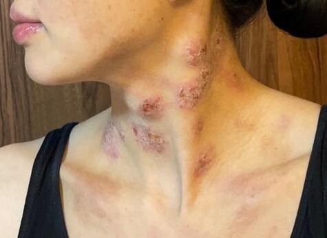 脱保湿の肌の様子2023.06.07